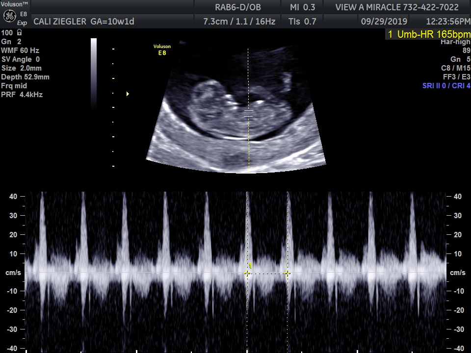 7 week ultrasound heartbeat