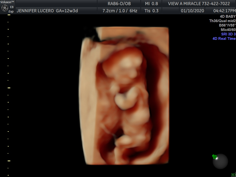 Week by Week Ultrasound Gallery - 2D 3D 5D Visual Pictures