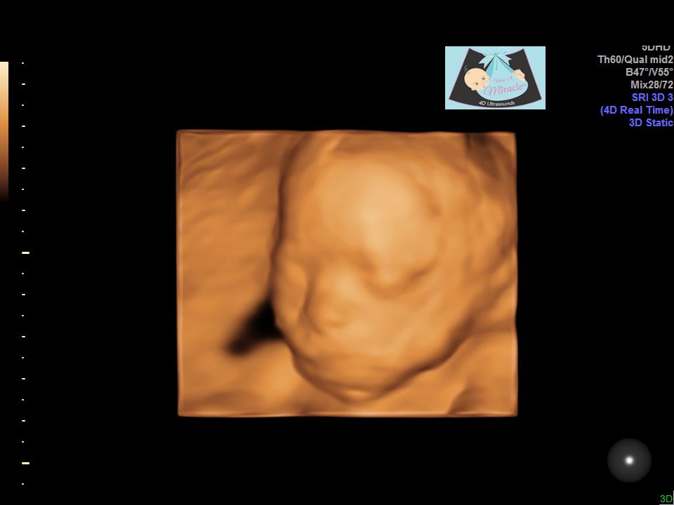 35 week 3d ultrasound