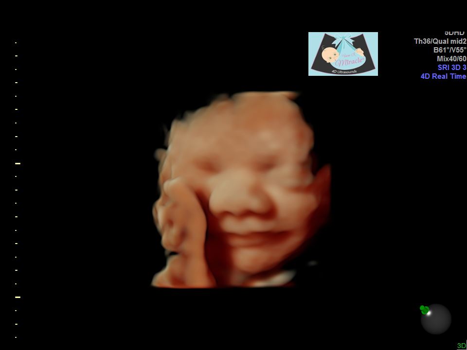 Is 5D/HD LIVE Ultrasound Worth the Extra Expense?