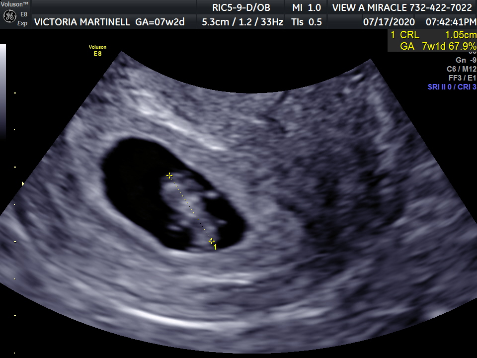 7 week ultrasound 3d
