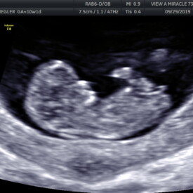 10 weeks pregnant ultrasound